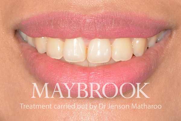 After Discreet White Braces in Soho