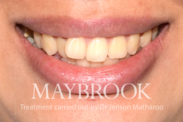Before Discreet White Braces in Soho