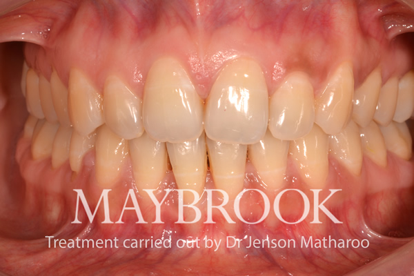 after Discreet White Braces in Soho