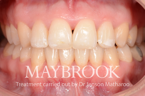 After Discreet White Braces in Soho