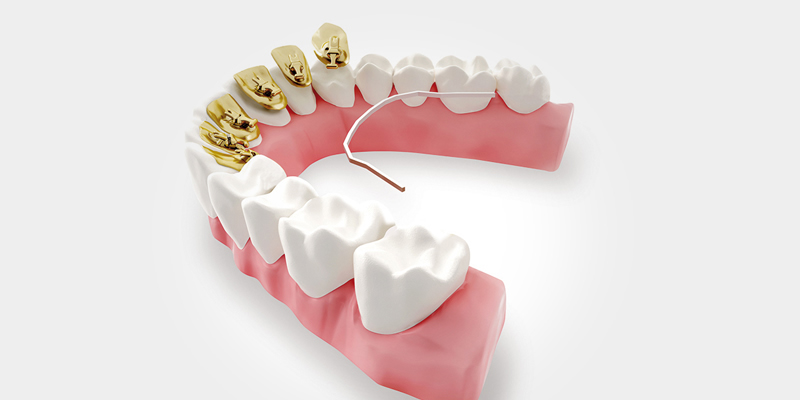 Incognito lingual braces at Maybrook Clinic in Soho